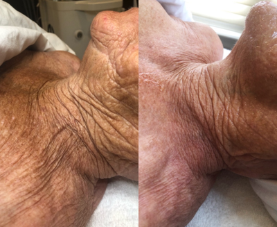 75 and up year old woman treated with Forma - Results following Forma Skin Tightening treatments.