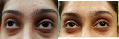 22 year old woman treated with Carboxytherapy - 22 years old whowomantreated with12 sessions of Carboxytherapy for under eye dark circles