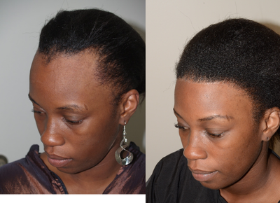 Hairline Advancement - Before and After Hairline Advancement /Forehead Shortening Surgery facilitated by tissue expansion, followed by 1500 grafts to round out the hairline.