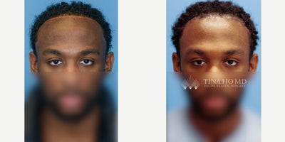 18-24 year old man treated with Forehead Reduction - 22 year-old male who underwent forehead reduction or hairline lowering surgery to advance his hairline and reduce the height of his forehead.