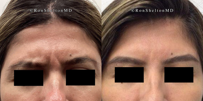 45-54 year old woman treated with Jeuveau - 3 days after Jeuveau for frown lines