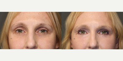 Enigmalift and Fat Grafting with Laser - Enigmalift scarless lower eyebag removal with periocular fat grafting and laser resurfacing.