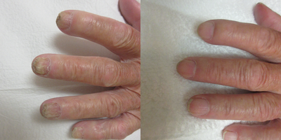 75 and up year old man treated with Laser Toenail Fungus Removal - A Better Way to Treat Toenail FungusToenail fungus affects countless people and can be due to several causes. Until recently, there have not been many options for people suffering from toenail fungus. Traditional treatments are often times not effective and even harmful to your body. These treatments include: topical medicine (applied for 12 months and rarely effective), oral medication (taken for 3 months and can cause problems with the liver and kidneys), and nail trimming.It is now available the latest advancement in lasers, including the Fotona laser treatment to quickly and effectively treat toenail fungus in 4 quick treatments.How Laser Toenail Fungus Removal Works:The Fotona ClearSteps treatment works by using Nd:YAG laser light to heat evenly throughout the depth of the effected nail and skin tissue, effectively weakening and killing parasitic fungi which have infected the patients nails. Procedure times may vary but are typically completed within 20 minutes. Most patients experience complete loss of toenail fungus with just 4 treatments at 1 week intervals.