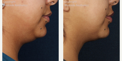 Kybella Double Chin Treatment - This 29-year-old female patient was concerned with her double chin, so Dr. Rivkin administered Kybella, a nonsurgical injectable to reduce moderate to severe fat below the chin (submental fat).
