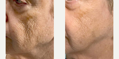 75 and up year old woman treated with Potenza - Older female over 80 - before and after of Potenza, full face, 3 treatments.
