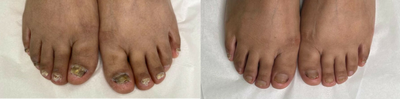 25-34 year old woman treated with Laser Toenail Fungus Removal - The Candela Gentlemax Pro has a special attachment to clear the nails of Toe Fungus. The client completed 5 treatments on all toes at 4 week intervals. It took the nails 8-9 months to grow out fully clear.