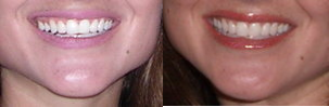 Full Lip - 
	Permanent lip makeup posted under&nbsp;&ldquo;Not if You Are Under 50!!&rdquo;
