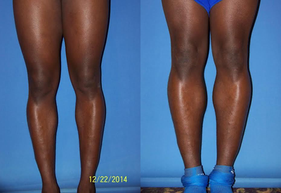 Calf Implant - 35 year old gentlemen two weeks after calf implants, medial and lateral, performed by Dr Sam Gershenbaum