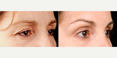 Woman treated with ULTRAcel - Woman treated with ULTRAcel