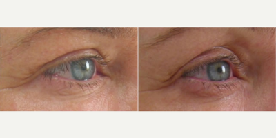 Woman treated with ULTRAcel - Woman treated with ULTRAcel