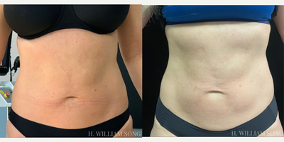 35-44 year old woman treated with truFlex - Looking non-invasive way to achieve a toned appearance? Check out TruSculpt Flex, a muscle sculpting device that mimics a workout in a 45 minute session. 1 Session 34,000 crunches!
