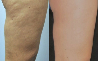 Woman treated with Velashape - Woman treated with Velashape