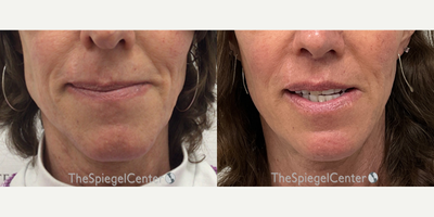 55-64 year old woman treated with Jaw Surgery - Mandible Contouring