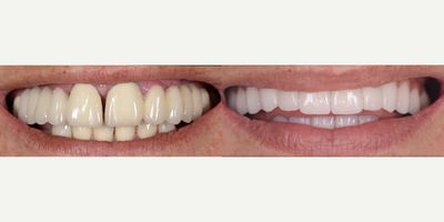 45-54 year old woman treated with Full Mouth Reconstruction - Implants All on 6, for full mouth reconstruction with zirconium crowns for upper jaw and lower jaw with Smile makeover with zirconium crowns.