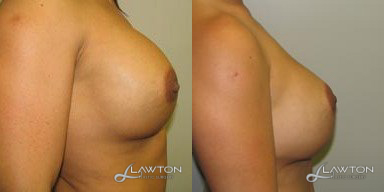 Breast Implant Revision - Age: 35 Height: 54 Weight (lbs): 142 Volume (cc): 750 Pre/Post: 38D/38D Follow Up (months): 1