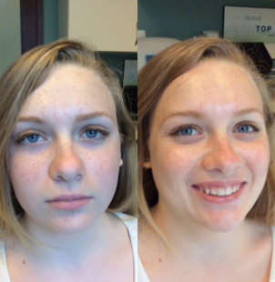 HydraFacial - Woman treated with HydraFacial