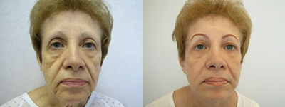 Woman treated with Facelift - Woman treated with Facelift