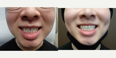 18-24 year old man treated with Dimple Surgery - Timeless Dimple, Dimple Creation