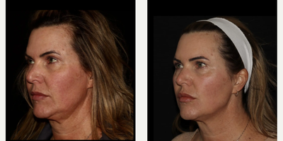 Woman treated with Emface - Emface