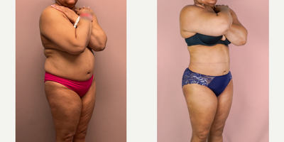 55-64 year old woman treated with Liposuction, Brazilian Butt Lift - This patient underwent a 360 Liposuction procedure with fat grafting to the buttocks/hips.
