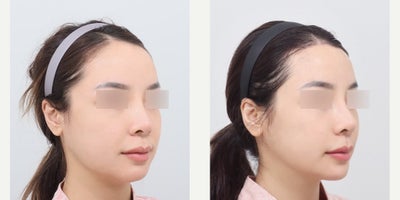 25-34 year old woman treated with MACS Lift + Forehead Reduction + Full-Face Fat Grafting - From Tired to Refreshed -> MACS Lift + Forehead Reduction + Full-Face Fat GraftingBefore the procedure, facial sagging was visible in the midface and jawline, the forehead appeared relatively long, and overall facial volume was uneven or depleted, creating a tired and aged appearance.After the procedure, the MACS Lift effectively repositioned sagging tissues for a firmer, more lifted midface and jawline, while forehead reduction improved facial proportions by shortening the upper face. Full-face fat grafting restored natural volume to hollow areas, enhancing contours and skin vitality, resulting in a more youthful, balanced, and harmonious facial appearance.