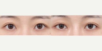 25-34 year old woman treated with Non-Incisional Double Eyelid (Ptosis) + Low Canthoplasty + Lateral Canthoplasty - Non-Incisional Double Eyelid (Ptosis) + Low Canthoplasty + Lateral CanthoplastyBefore the procedure, the eyes appeared tired and smaller due to mild ptosis, with an unclear eyelid crease and short eye length that made the outer corners look slightly upturned.After the procedure, a natural non-incisional double eyelid crease was created while correcting ptosis to improve eye opening, resulting in brighter and more defined eyes. Low canthoplasty softened the inner corners, and lateral canthoplasty extended the outer eye line, creating a wider, longer, and more balanced eye shape while maintaining a natural look.