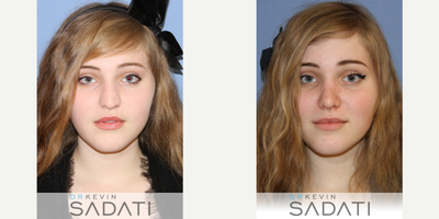 Open Septo-Rhinoplasty Procedure on Orange County Female - Open Septo-Rhinoplasty Procedure on Orange County Female