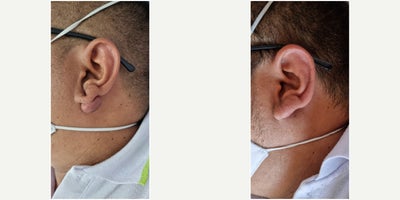 35-44 year old man treated with Scar Removal - Queloid scar removarl