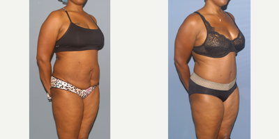 35-44 year old woman treated with Tummy Tuck - Full tummy tuck with muscle repair, note how vertical c-section scar has been traded for a transverse tummy tuck scar that is hidden.