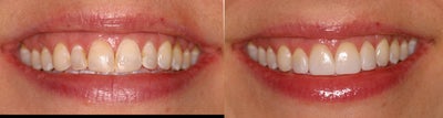 Deep bleaching and porcelain veneers - Patient had bonding done on front teeth years ago which had discolored and chipped over time. Patient had always wanted to whiten but was concerned about sensitivity and knew that with her previous bonding she would need to have that replaced after bleaching (tooth bonded fillings do not bleach like natural teeth). After 2 in office deep bleaching sessions and 2 weeks of at home bleaching in between, Dr. Alfe placed conservative DURAthin minimal preparation porcelain veneers on the patient's front teeth to replace the worn and chipped bonding. Patient is thrilled with the uniform color and shape of her front teeth and smiles all the time now!