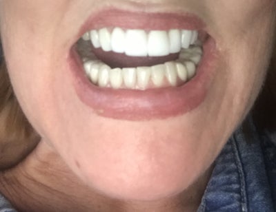 Veneers Not Happy Omer Kodan Uzmanlar Review Realself