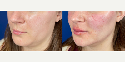 25-34 year old woman treated with Lip Fillers - Patient treated with fillers for lips and jawline. Photos are immediately before and after the procedure.