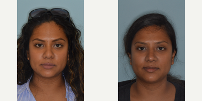 25-34 year old woman treated with Revision Rhinoplasty - This patient who had undergone a previous rhinoplasty was seeking to refine the tip and narrow the nose. She was not concerned about her profile view. She was noted to have thicker nasal skin. She was found intra-operatively to have had previous de-fatting of the skin and tip cartilage reduction. Given her thick skin, she needed strong tip cartilage support to create refinements. Revision rhinoplasty techniques included caudal septal extension graft and tip only graft using cartilage from the septum.