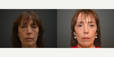 45-54 year old woman treated with Eyelid Surgery - This patient had a trans-conjunctival blepharoplasty with fat removal and an eyelid tightening canthoplasty
