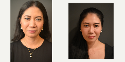 35-44 year old woman treated with Asian Rhinoplasty - Augmentation Asian Rhinoplasty and Tip elevation with alar base trim