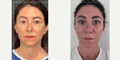45-54 year old woman treated with Mini Facelift, Lower Facelift, Vampire Facelift - 45-54 year old woman treated with Mini Facelift