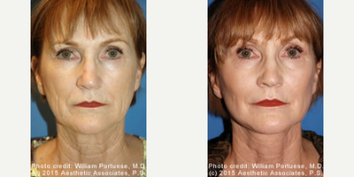 Woman treated with Cheek Implants - Woman treated with Cheek Implants