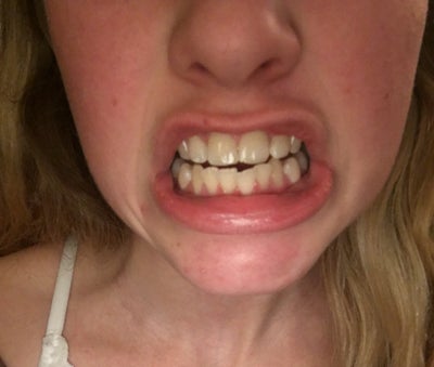 my teeth shifted after braces