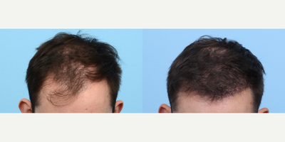 18-24 year old man treated with FUE Hair Transplant, Hair Transplant, Hair Loss Treatment, PRP for Hair Loss, PRP Injections - At 24 years old, this patient sought to increase their hair density and strengthen their hairline. Dr. Wise performed an FUE hair transplant procedure using 3,850 grafts and one session of PRP therapy. Significant results were noticeable six months post-surgery.