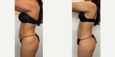 25-34 year old woman treated with Liposuction - 3 months post-op and shes slaying her new silhouette! Were beyond excited to share this amazing transformation from our FormSculpt procedure, targeting the upper & lower abdomen, waist, flanks, and lower back.Heres what makes this procedure a total game-changer: Awake & Comfortable  No heavy anesthesia needed! Minimal Downtime  She was up and about in no time. No Sutures, No Scars  Leaving her skin smooth and flawless. Snatched Waist, Rounded Hips  Contours that enhance her natural curves.
