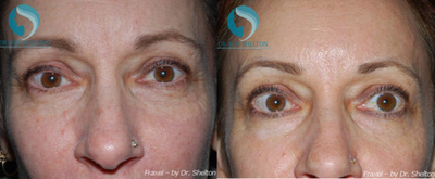 45-54 year old woman treated with Skin Lightening - Improvement of photo damage (sun damage) with One Fraxel Restore Dual laser. All treatments done by Dr. Shelton