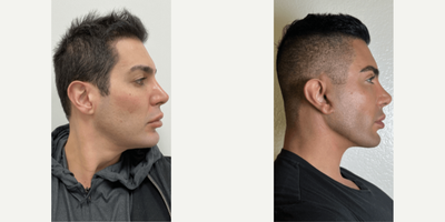 Man treated with Neck Lift - Man treated with Neck Lift