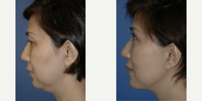 Woman treated with Neck Lift - Woman treated with Neck Lift