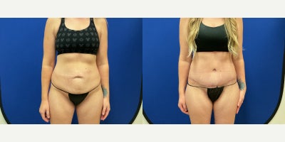 35-44 year old woman treated with Lipo 360, Tummy Tuck, Mommy Makeover, Diastasis Recti Repair - 39 year old female. tummy tuck and circumferential liposuction of the flanks