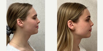 18-24 year old woman treated with Brow Bone Reduction, Brow Lift, Forehead Reduction - this is a young lady who under forehead reconstruction.