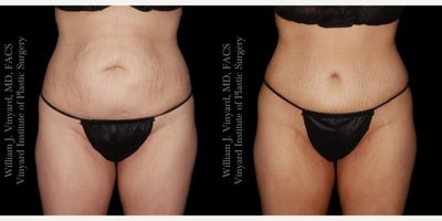 35-44 year old woman treated with Diastasis Recti Repair, Tummy Tuck - This 3544 year old female patient achieved significant weight loss but was left with excess skin, abdominal laxity, and muscle separation. Dr. Vinyard performed an abdominoplasty with rectus muscle plication, umbilicoplasty, and a mons pubis lift, restoring a flatter, firmer abdomen with a natural belly button design and smoother contour for a more balanced figure after weight loss.