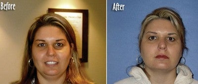 Mesotherapy to reduce double chin - Skinovative USA