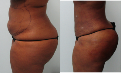 Gruber Booty - Lipo Only, No Implant, No Fat Transfer, No Injections - liposuction, tiny pinpoint scars, minimal 3 day downtime, easy recovery. by&nbsp;Dr. Gruber&nbsp;