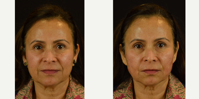 Enhancement of the Midface and Lower Third with Novathreads  Non-Surgical Rejuvenation - This 54-year-old female who was not ready to undergo surgery was very thrilled once she learned about the NovaLift. A non-surgical, office based procedure, done under local anesthetic. Her results, shown immediately after the procedure, illustrate lifting of the cheeks and softening of the jowls. As the threads work to lift and tighten the facial tissues, we notice the significant improvement to her smile lines. Results typically last 6-12 months depending on the amount of threads used and the heaviness of the patients facial tissues.