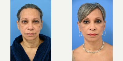 55-64 year old woman treated with Facelift Revision, Facelift, Neck Lift - 55 year old woman now 3 months after secondary face, neck and lateral brow lift procedure performed by Dr Sam Gershenbaum. She had a face / neck lift as well as her eyelids done previously in 2018 by another surgeon. She was not happy with her results and poor scarring. Now, 3 months post op, she thrilled with her new contours and younger, fresher look as well as a dramatic improvement in her scars that will continue to heal even better over the months ahead.